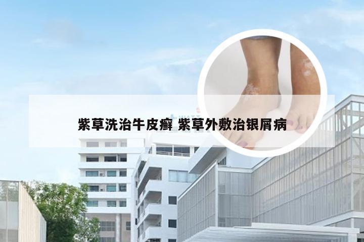 紫草洗治牛皮癣 紫草外敷治银屑病