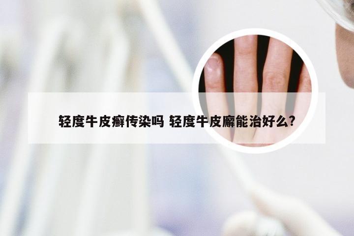 轻度牛皮癣传染吗 轻度牛皮廨能治好么?