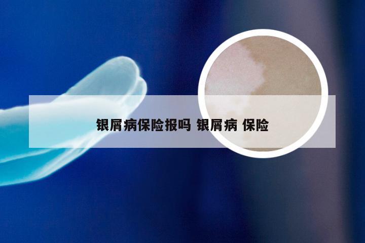 银屑病保险报吗 银屑病 保险