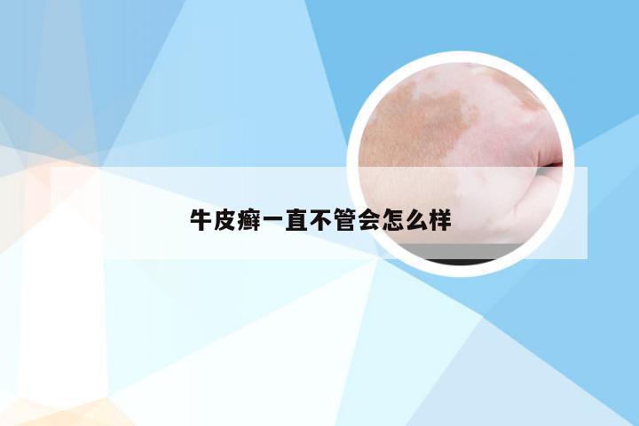 牛皮癣一直不管会怎么样