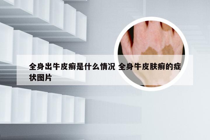 全身出牛皮癣是什么情况 全身牛皮肤癣的症状图片