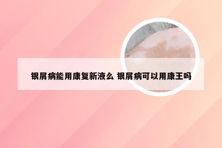 银屑病能用康复新液么 银屑病可以用康王吗