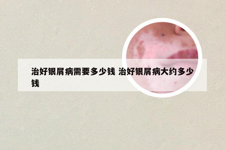 治好银屑病需要多少钱 治好银屑病大约多少钱