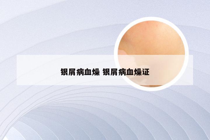 银屑病血燥 银屑病血燥证