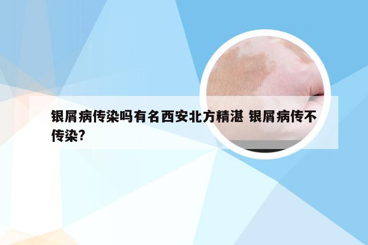 银屑病传染吗有名西安北方精湛 银屑病传不传染?
