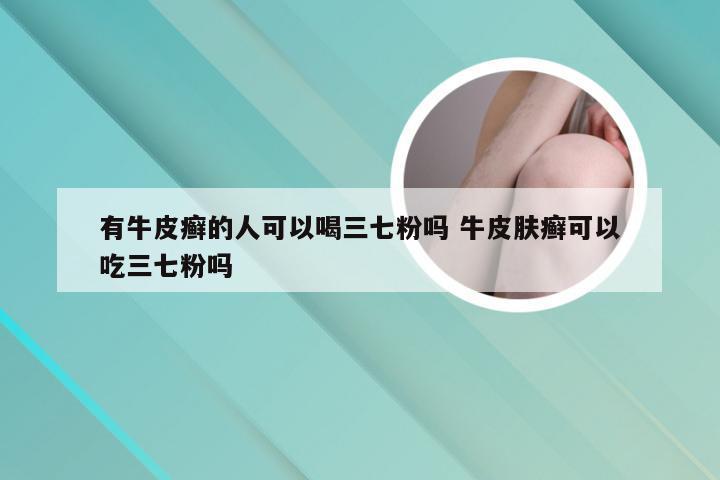 有牛皮癣的人可以喝三七粉吗 牛皮肤癣可以吃三七粉吗