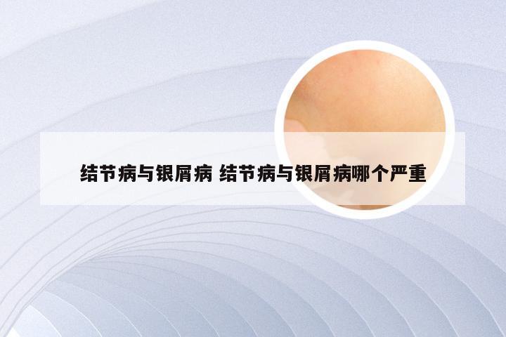 结节病与银屑病 结节病与银屑病哪个严重