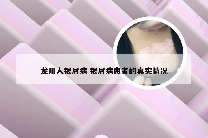 龙川人银屑病 银屑病患者的真实情况