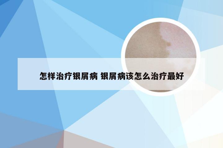 怎样治疗银屑病 银屑病该怎么治疗最好