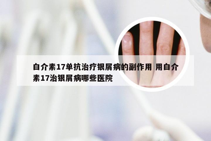 白介素17单抗治疗银屑病的副作用 用白介素17治银屑病哪些医院