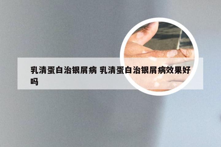 乳清蛋白治银屑病 乳清蛋白治银屑病效果好吗
