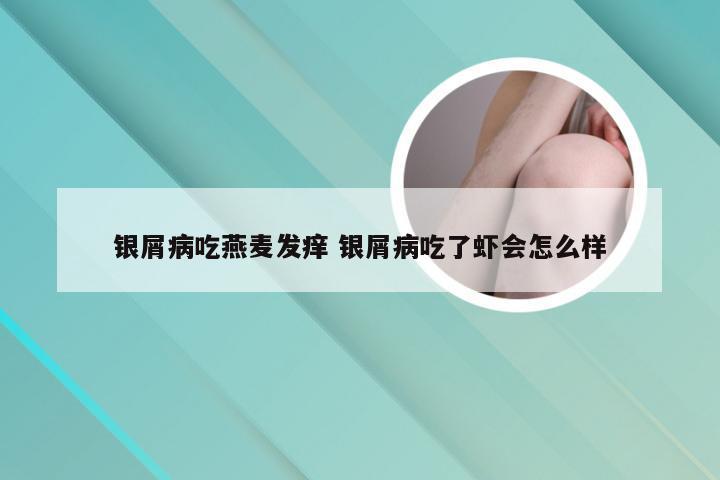 银屑病吃燕麦发痒 银屑病吃了虾会怎么样