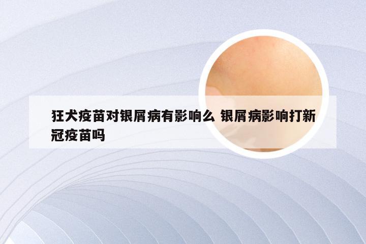 狂犬疫苗对银屑病有影响么 银屑病影响打新冠疫苗吗