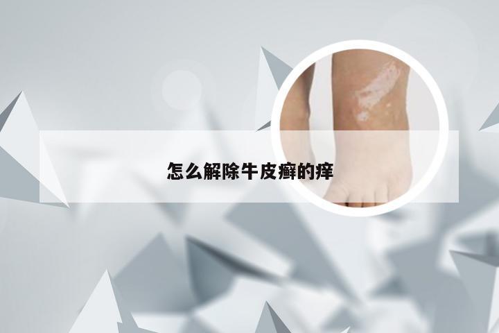 怎么解除牛皮癣的痒