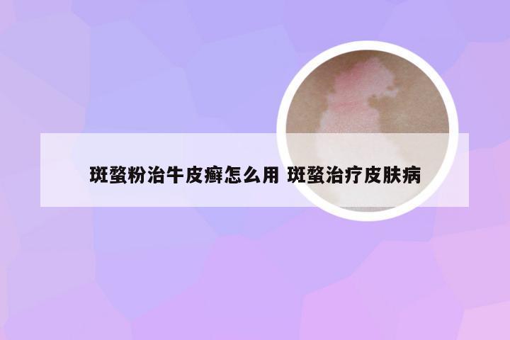 斑蝥粉治牛皮癣怎么用 斑蝥治疗皮肤病