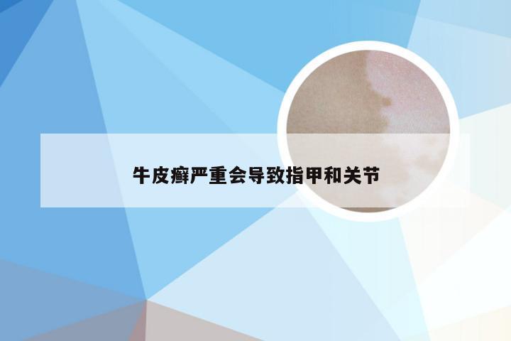 牛皮癣严重会导致指甲和关节