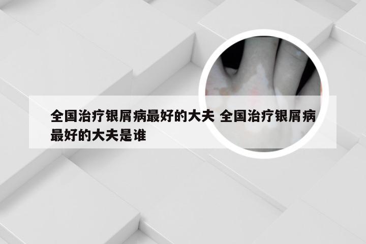 全国治疗银屑病最好的大夫 全国治疗银屑病最好的大夫是谁
