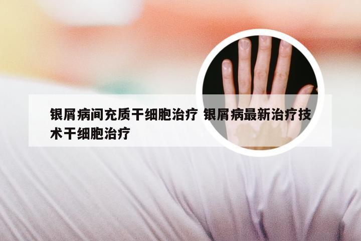 银屑病间充质干细胞治疗 银屑病最新治疗技术干细胞治疗