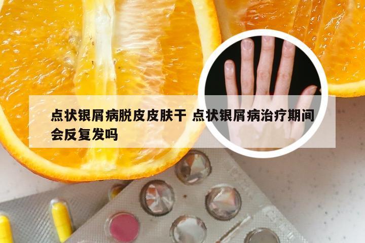 点状银屑病脱皮皮肤干 点状银屑病治疗期间会反复发吗