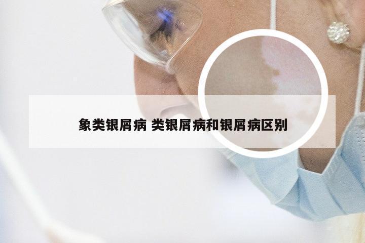 象类银屑病 类银屑病和银屑病区别