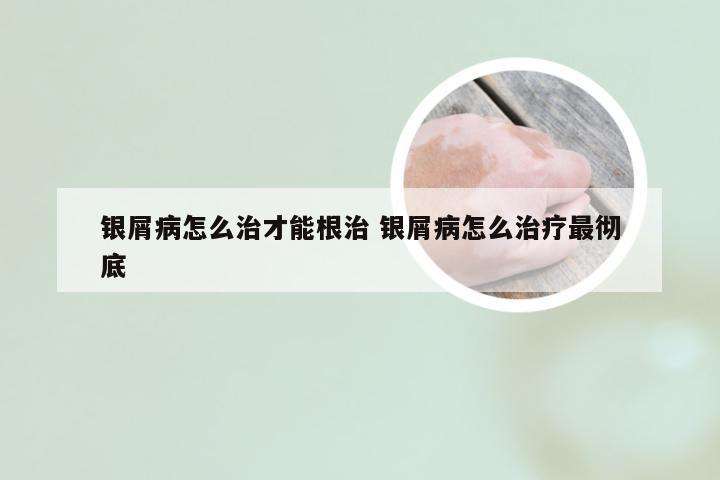 银屑病怎么治才能根治 银屑病怎么治疗最彻底