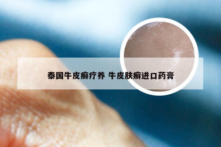 泰国牛皮癣疗养 牛皮肤癣进口药膏