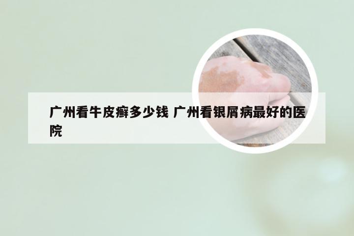 广州看牛皮癣多少钱 广州看银屑病最好的医院