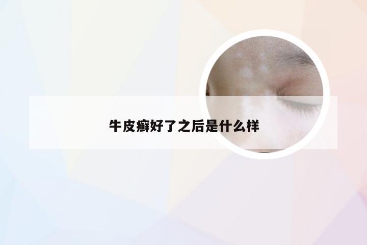 牛皮癣好了之后是什么样