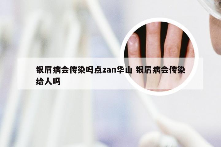 银屑病会传染吗点zan华山 银屑病会传染给人吗