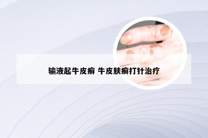 输液起牛皮癣 牛皮肤癣打针治疗