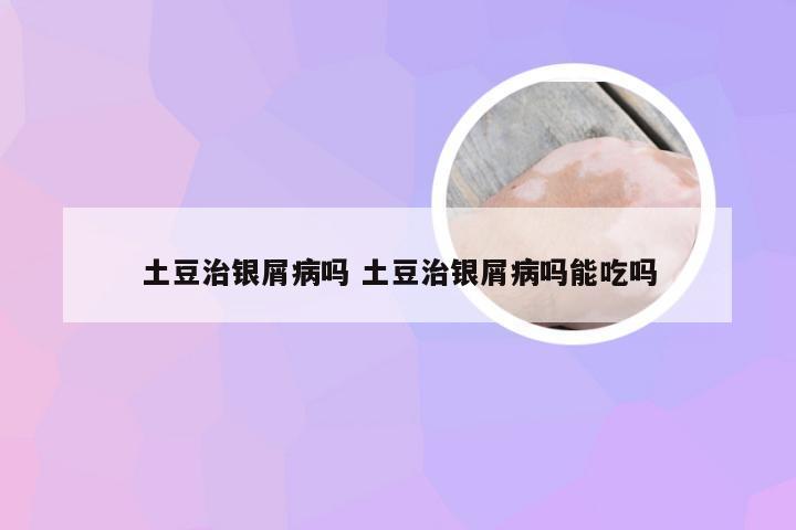 土豆治银屑病吗 土豆治银屑病吗能吃吗