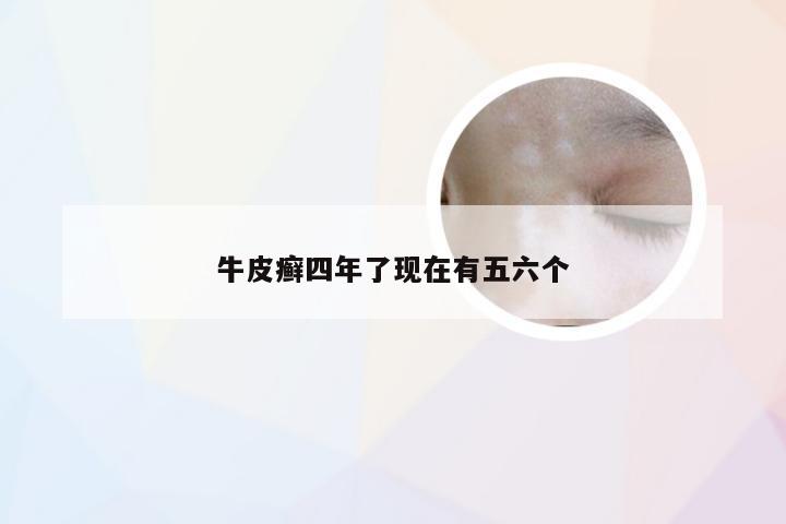 牛皮癣四年了现在有五六个