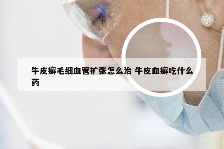 牛皮癣毛细血管扩张怎么治 牛皮血癣吃什么药