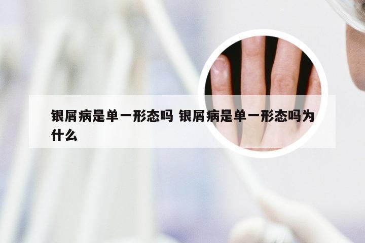 银屑病是单一形态吗 银屑病是单一形态吗为什么