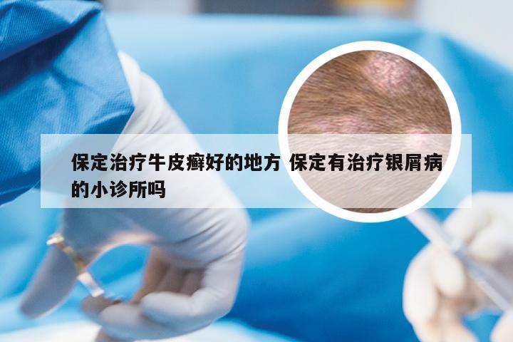 保定治疗牛皮癣好的地方 保定有治疗银屑病的小诊所吗