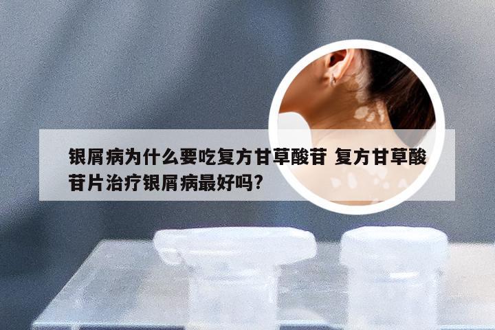 银屑病为什么要吃复方甘草酸苷 复方甘草酸苷片治疗银屑病最好吗?