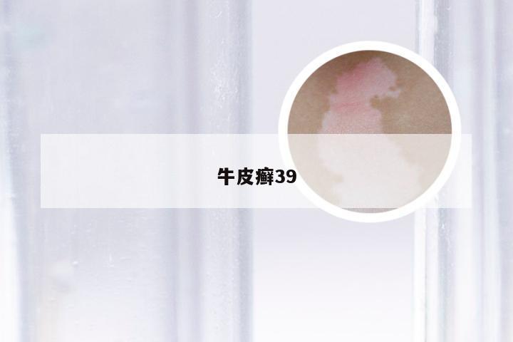 牛皮癣39