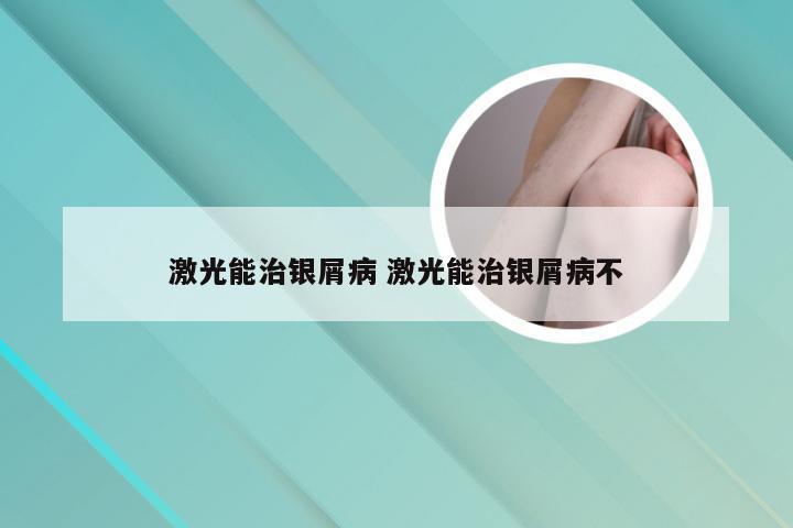 激光能治银屑病 激光能治银屑病不