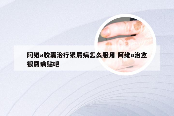 阿维a胶囊治疗银屑病怎么服用 阿维a治愈银屑病贴吧