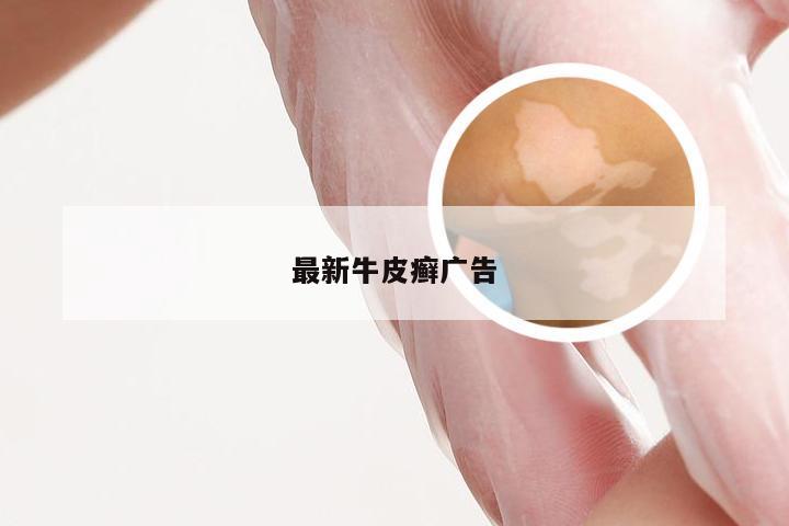 最新牛皮癣广告