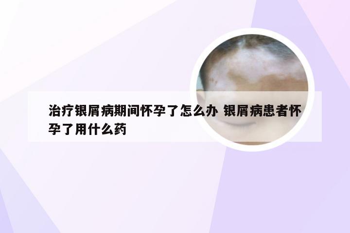 治疗银屑病期间怀孕了怎么办 银屑病患者怀孕了用什么药