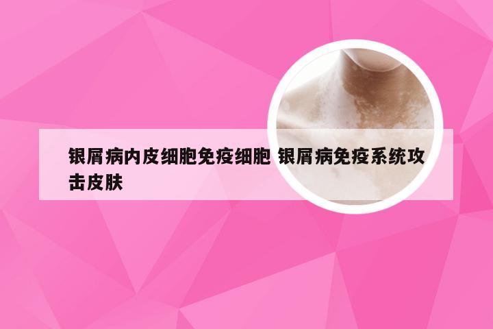 银屑病内皮细胞免疫细胞 银屑病免疫系统攻击皮肤