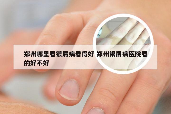 郑州哪里看银屑病看得好 郑州银屑病医院看的好不好
