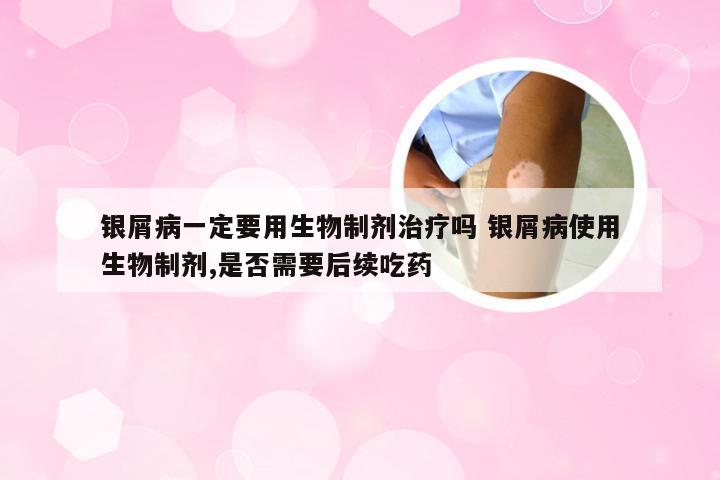 银屑病一定要用生物制剂治疗吗 银屑病使用生物制剂,是否需要后续吃药