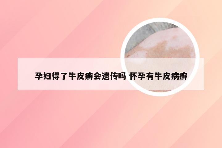 孕妇得了牛皮癣会遗传吗 怀孕有牛皮病癣