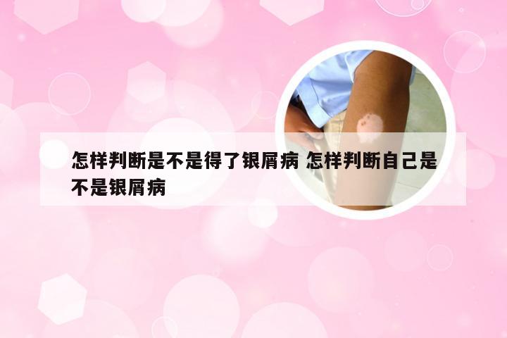 怎样判断是不是得了银屑病 怎样判断自己是不是银屑病