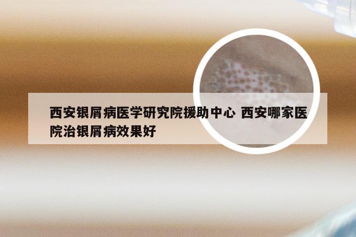 西安银屑病医学研究院援助中心 西安哪家医院治银屑病效果好
