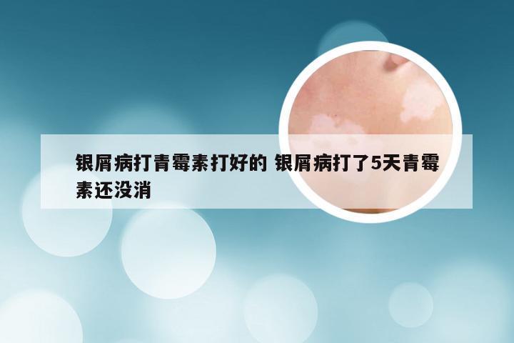 银屑病打青霉素打好的 银屑病打了5天青霉素还没消