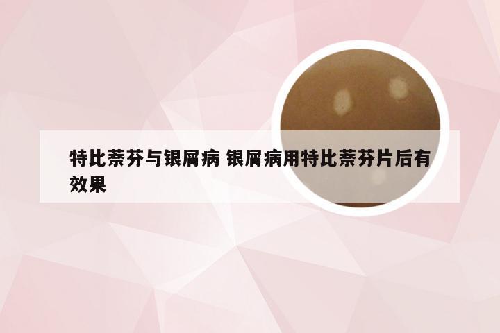 特比萘芬与银屑病 银屑病用特比萘芬片后有效果