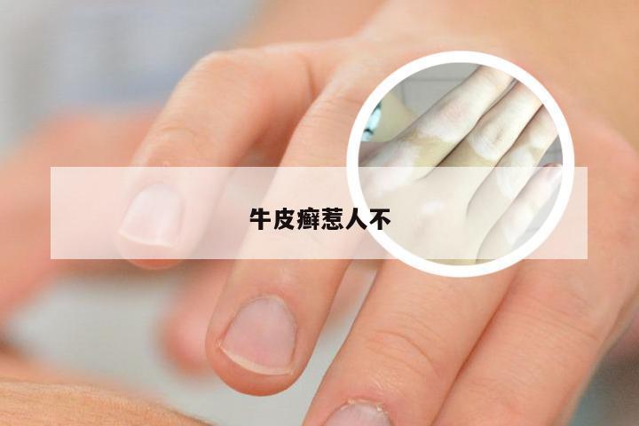 牛皮癣惹人不